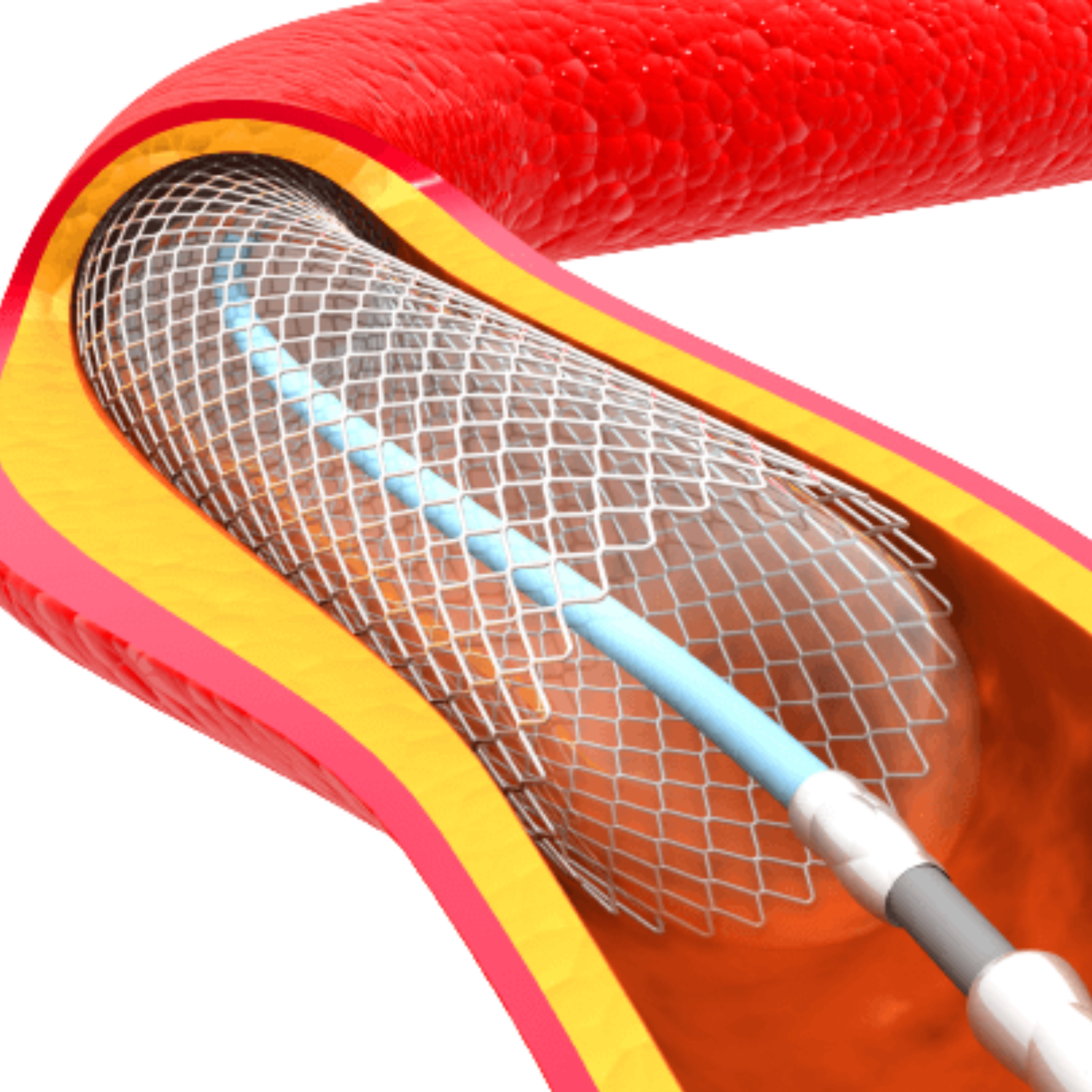 Balloon Angioplasty