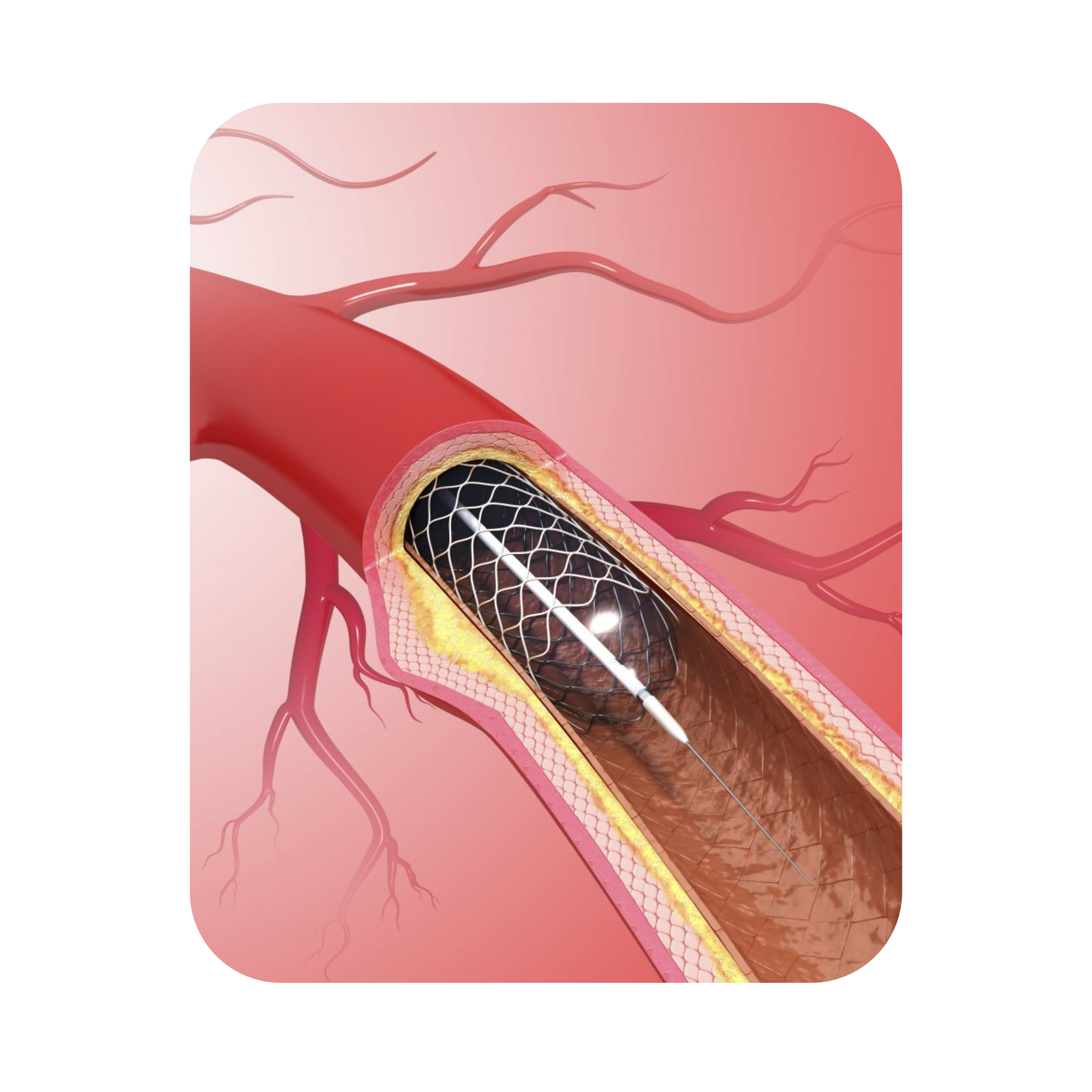 Angiography & Angioplasty